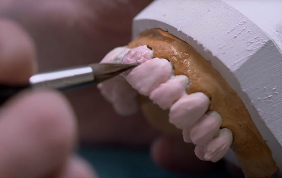 Vervaardigen van de kroon, brug of prothese Vervaardigen van de kroon, brug of prothese